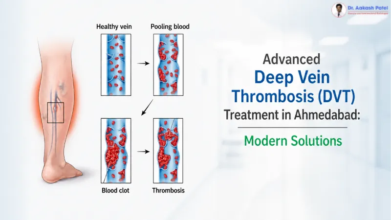 Advanced Deep Vein Thrombosis Dvt Treatment In Ahmedabad Modern Solutions — Dr. Aakash Patel