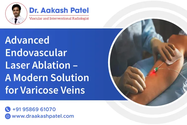 Advanced Endovascular Laser Ablation – A Modern Solution for Varicose Veins