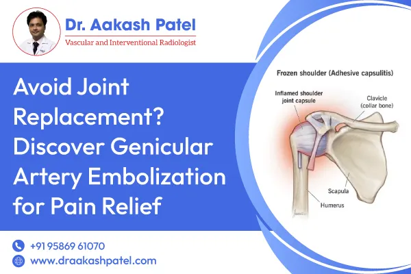 Avoid Joint Replacement? Discover Genicular Artery Embolization for Pain Relief – Dr. Aakash Patel