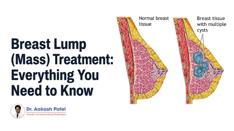 Breast Lump Mass Treatment Everything You Need To Know — Dr. Aakash Patel