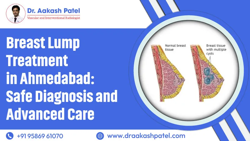 Breast Lump Treatment in Ahmedabad: Safe Diagnosis and Advanced Care – Dr. Aakash Patel