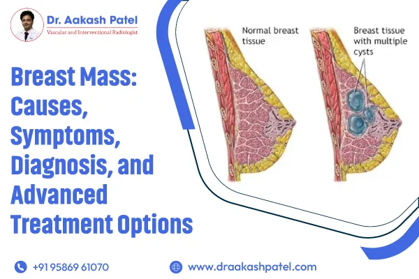 Breast Mass: Causes, Symptoms, Diagnosis, and Advanced Treatment Options – Dr. Aakash Patel