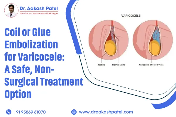 Coil or Glue Embolization for Varicocele: A Safe, Non-Surgical Treatment Option – Dr. Aakash Patel