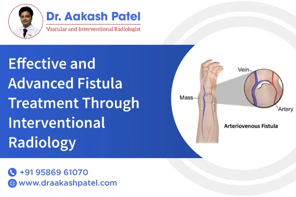 Effective and Advanced Fistula Treatment: Meet Dr. Aakash Patel
