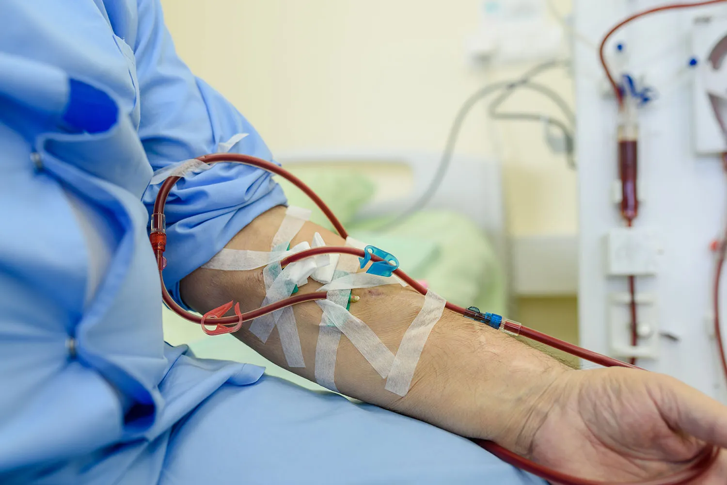 Expert Solutions for Dialysis Fistula Disease in Ahmedabad – Dr. Aakash Patel