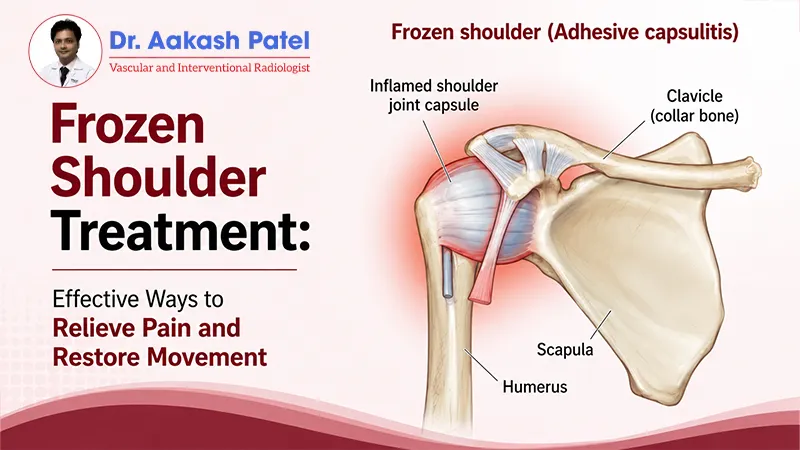 Frozen Shoulder Treatment: Effective Ways to Relieve Pain and Restore Movement — Dr. Aakash Patel