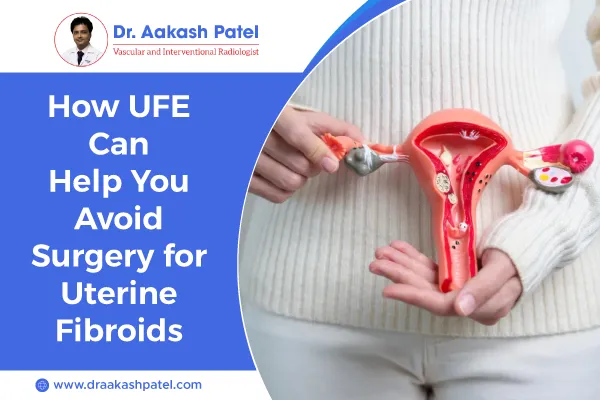 How UFE Can Help You Avoid Surgery for Uterine Fibroids