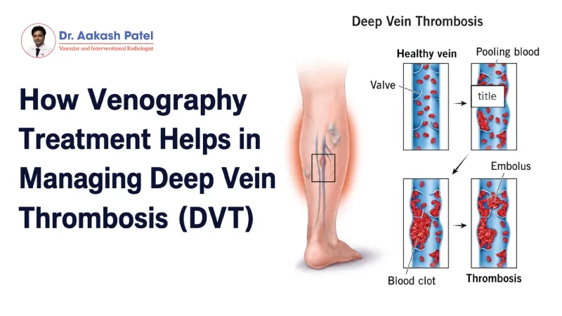 How Venography Treatment Helps In Managing Deep Vein Thrombosis Dvt — Dr. Aakash Patel