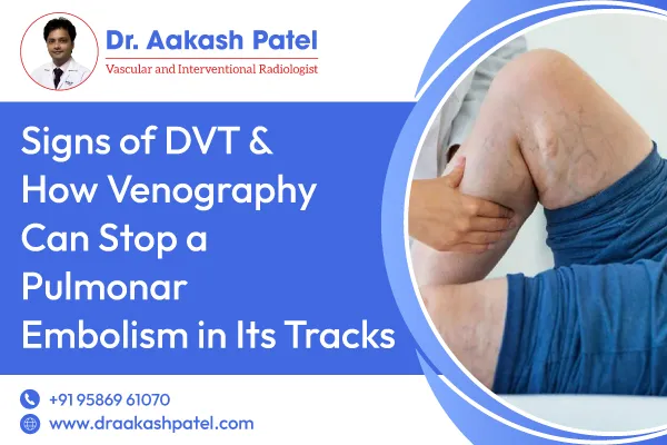 Signs of DVT & How Venography Can Stop a Pulmonary Embolism in Its Tracks – Dr. Aakash Patel