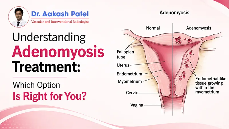 Understanding Adenomyosis Treatment: Which Option Is Right for You? — Dr. Aakash Patel