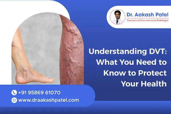 Understanding DVT: What You Need to Know to Protect Your Health