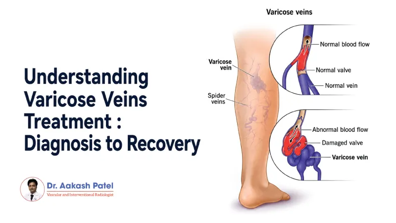 Understanding Varicose Veins Treatment Diagnosis To Recovery — Dr. Aakash Patel