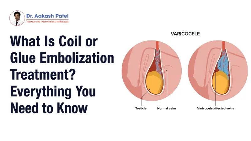 What Is Coil Or Glue Embolization Treatment Everything You Need To Know — Dr. Aakash Patel