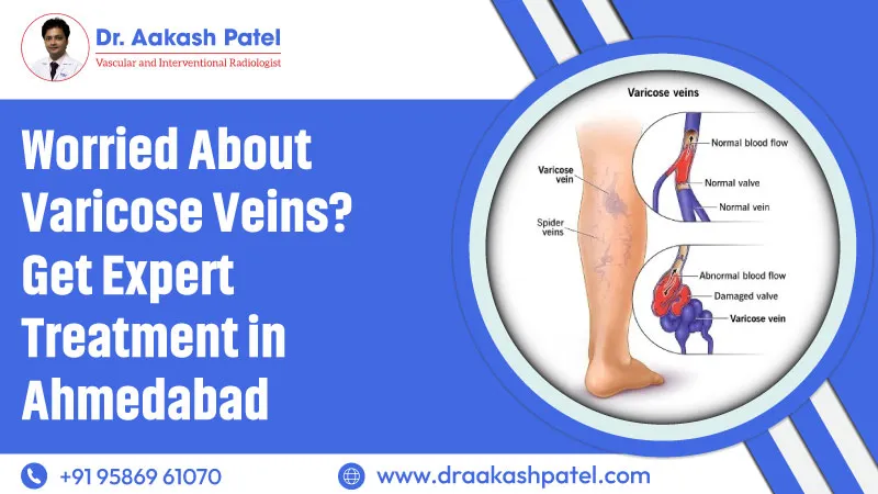 Worried About Varicose Veins? Get Expert Treatment in Ahmedabad – Dr. Aakash Patel